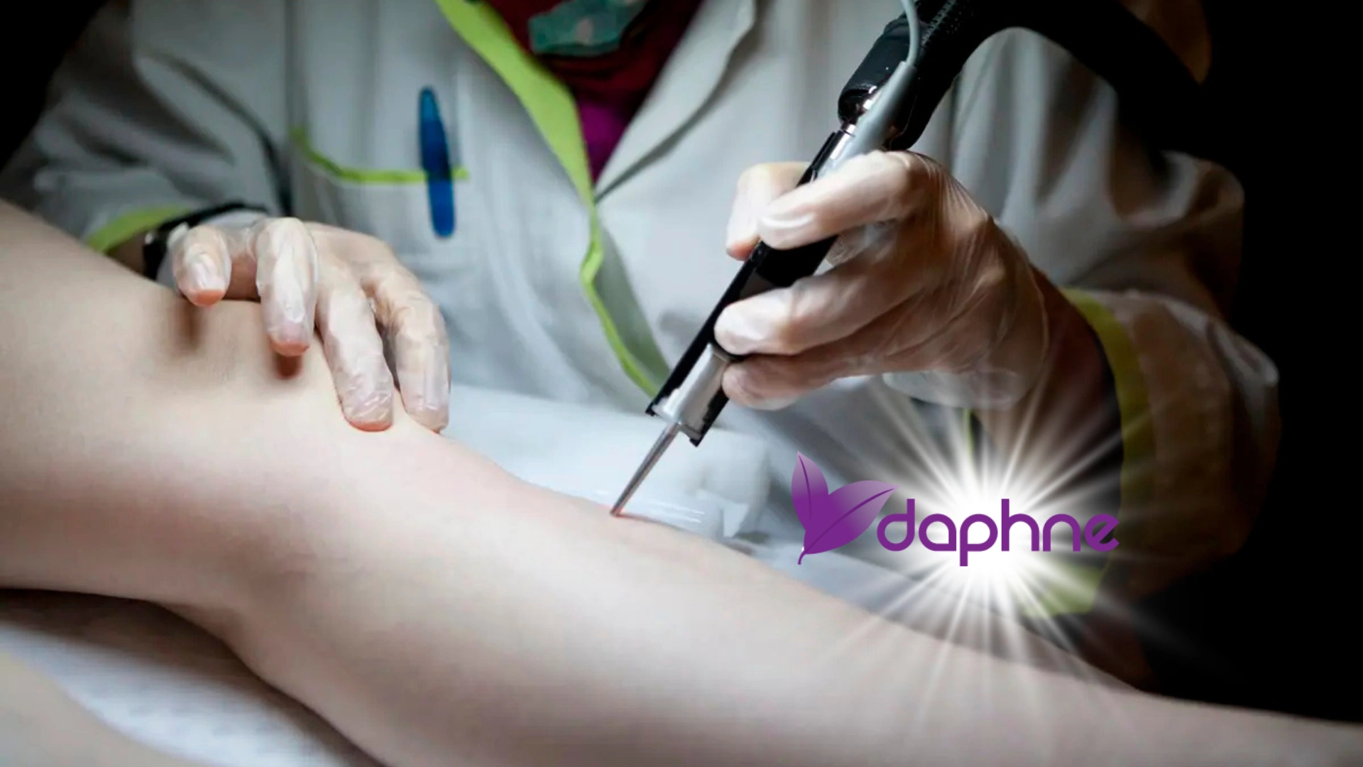 Alexandrit-Laser-Haarentfernung bei Daphne Laser in München