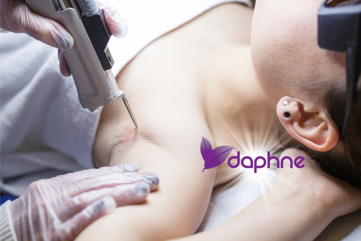 Nd:YAG Laser Haarentfernung in München